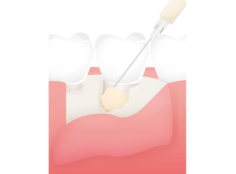 歯科再生療法