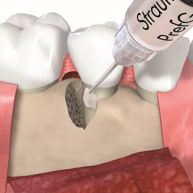エムドゲインを利用した歯周組織再生治療