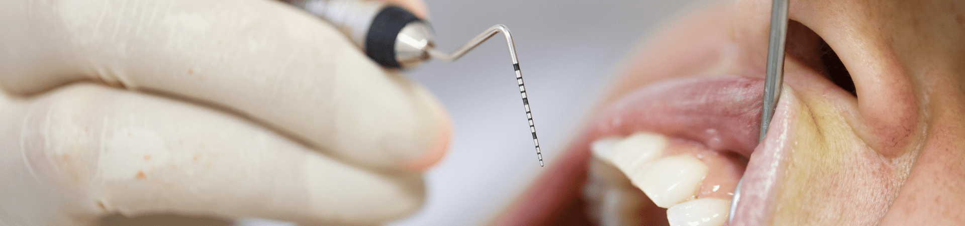 歯周病治療｜エンドウ歯科