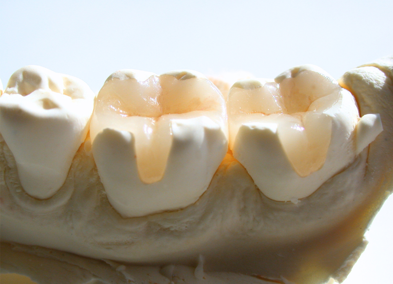 セラミック治療|エンドウ歯科