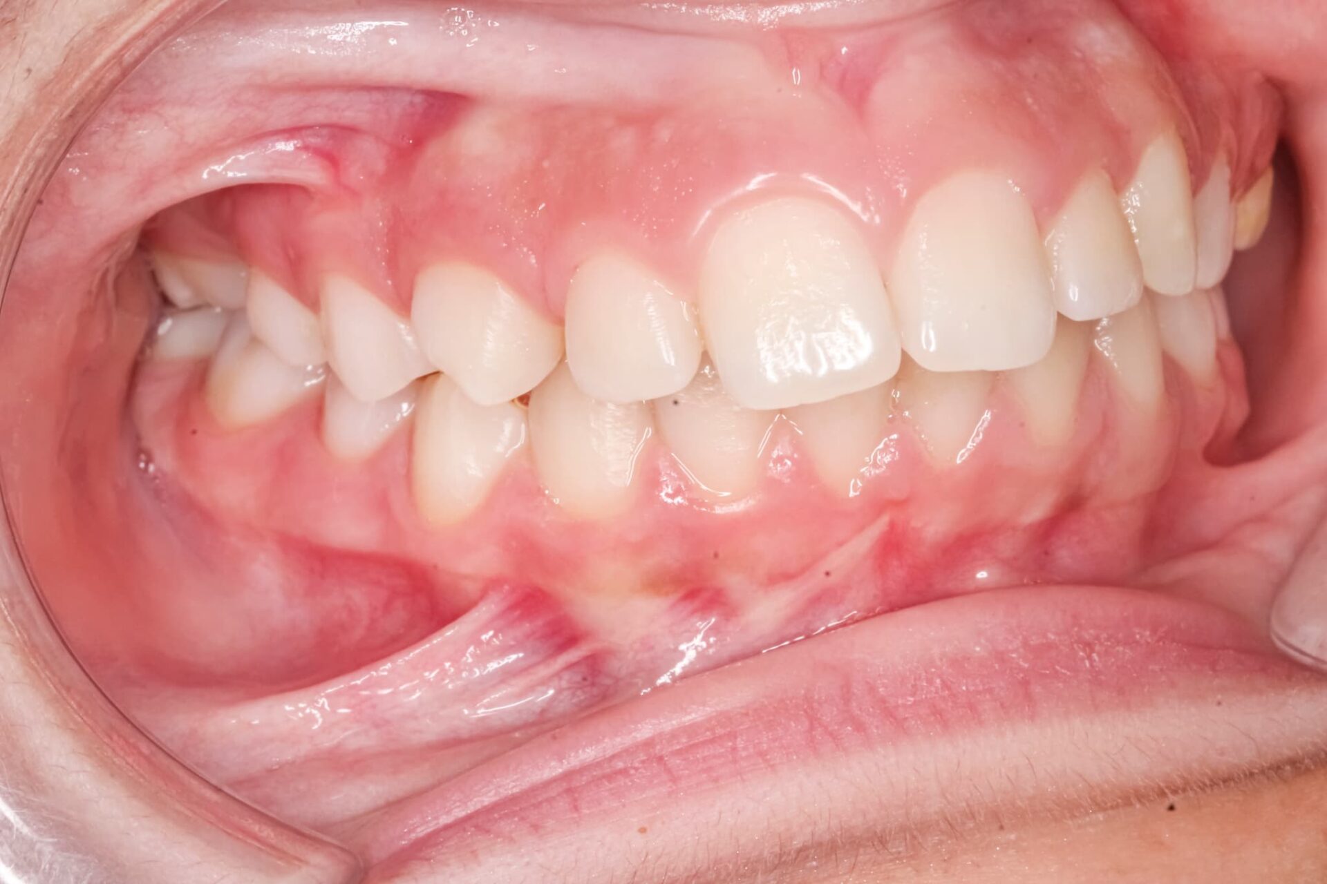 出っ歯の症例写真