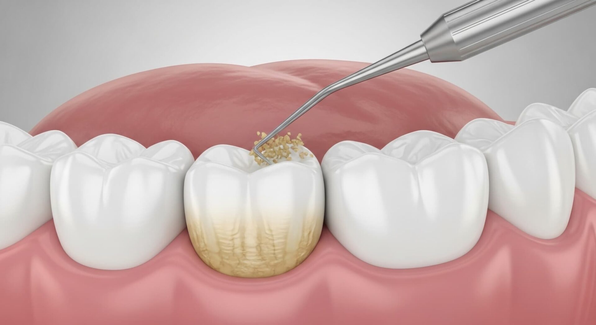 歯医者で歯石除去をする様子