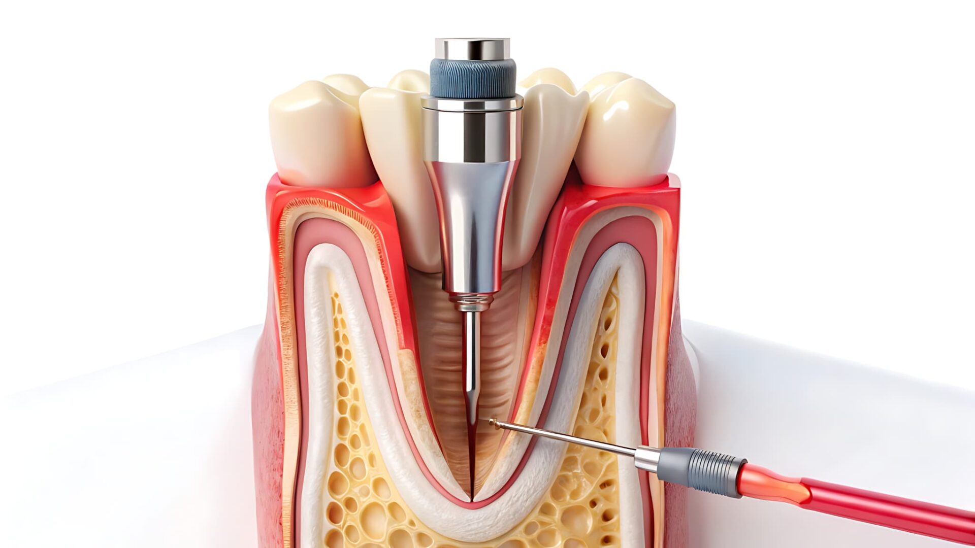 根管治療の様子