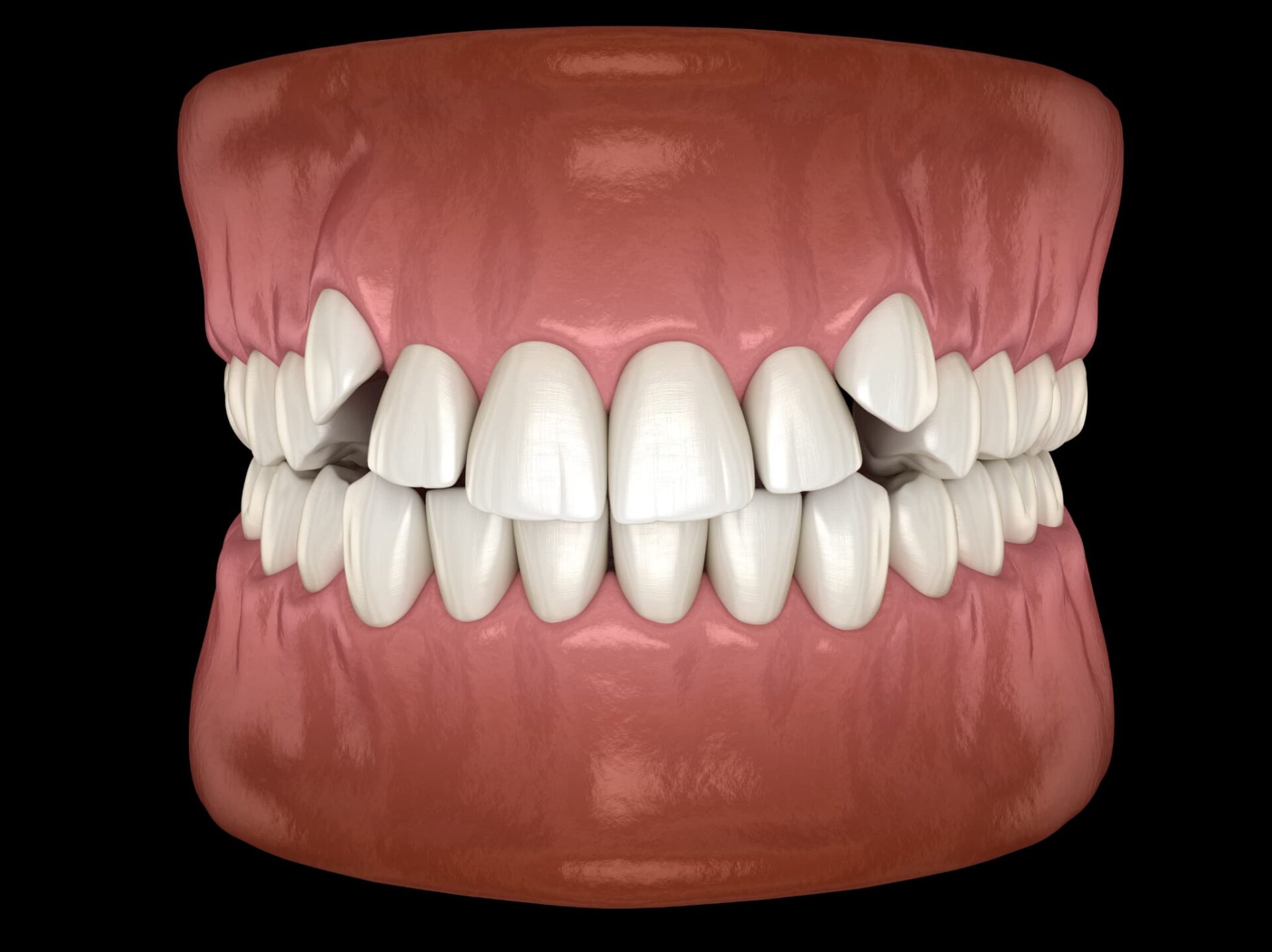 八重歯の3Dモデル画像