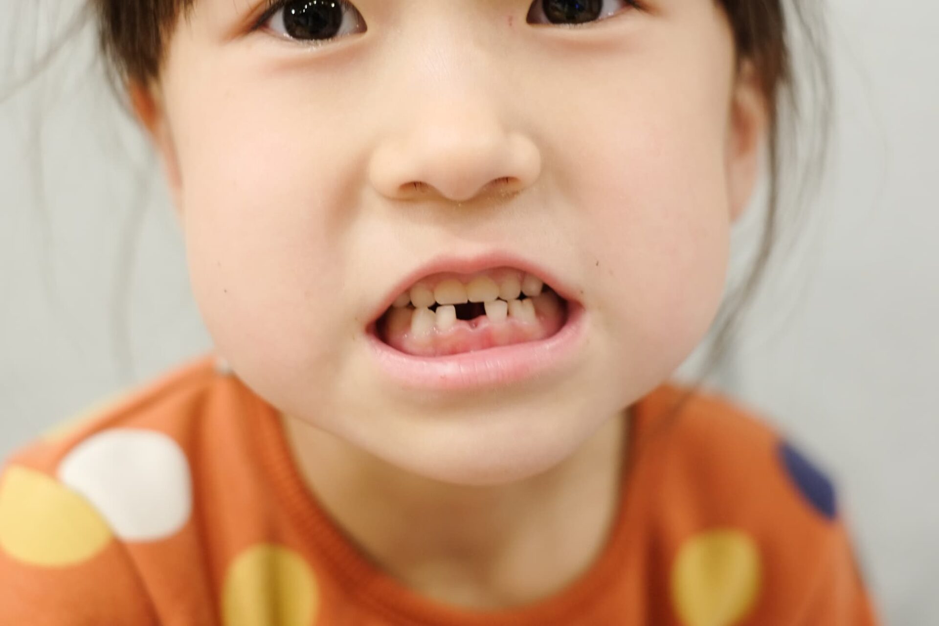 子どもの受け口を放置するリスクとは？矯正方法や治療費も解説