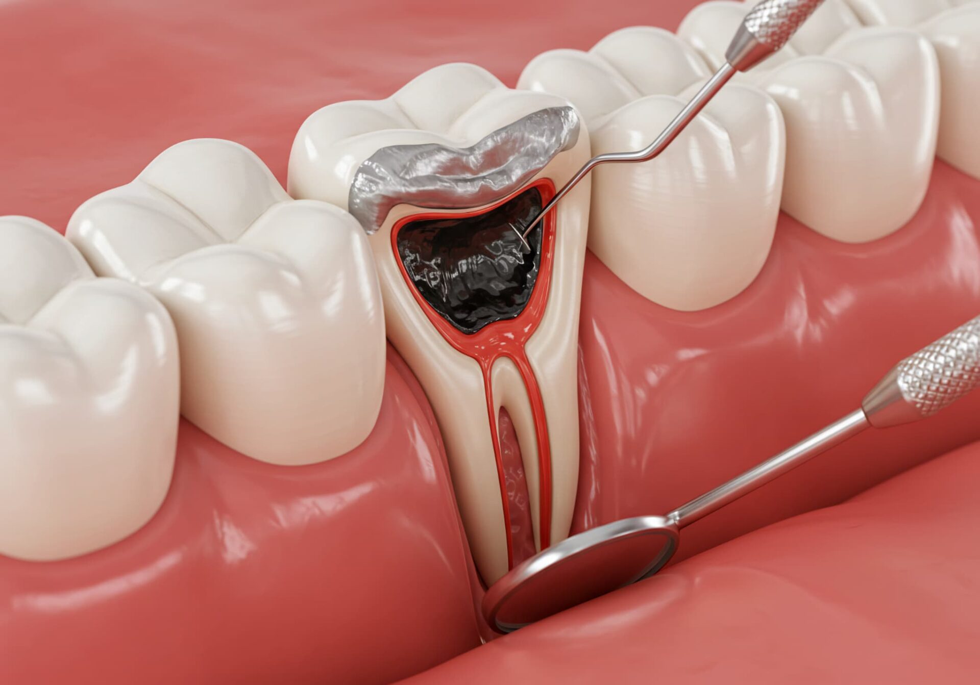 銀歯の下が虫歯になった様子