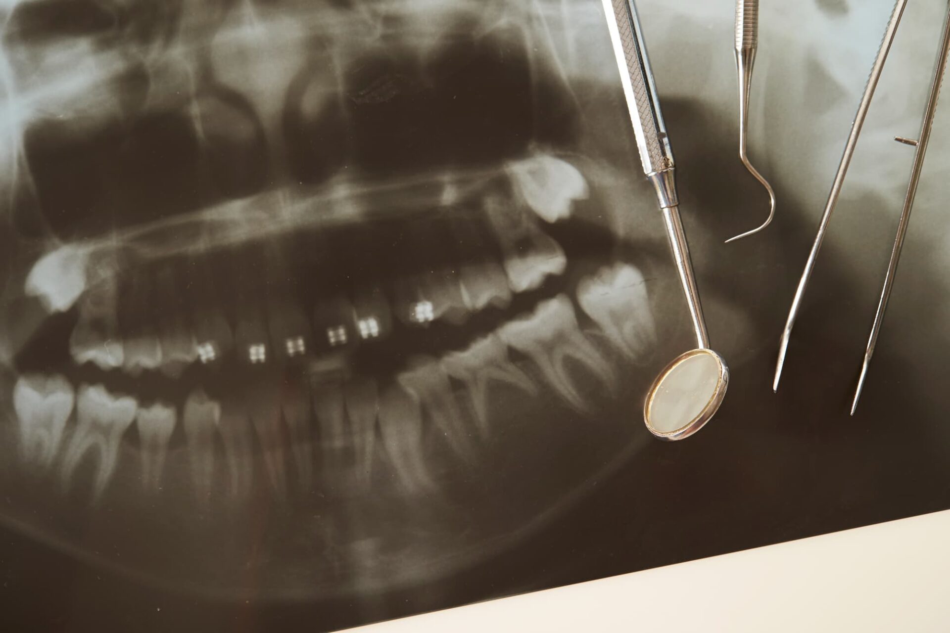 治療前に行うレントゲン検査