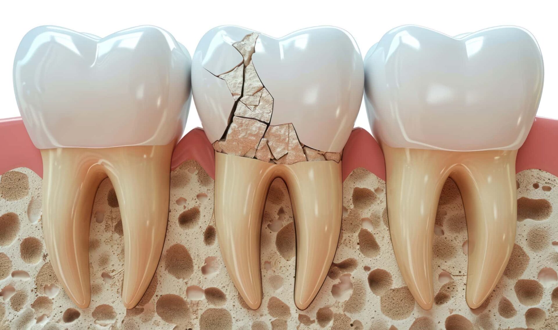 根管治療をしなかった為に歯が割れたイメージ