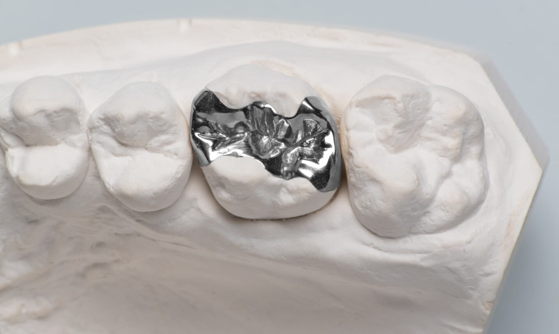 歯の治療に使用される銀歯