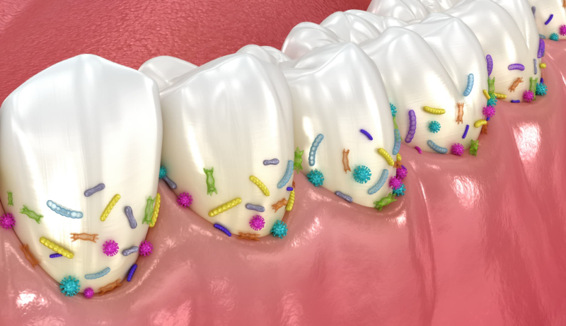 歯周病のメカニズムのイメージ