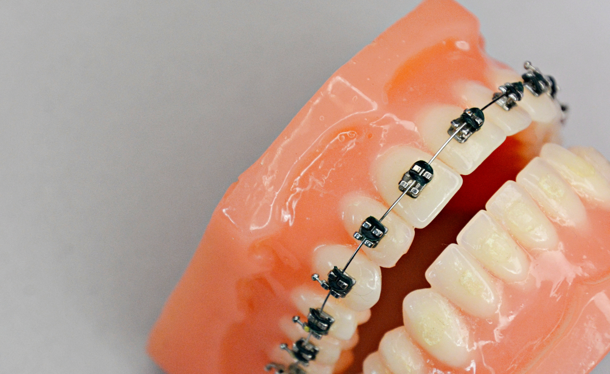 大人がすきっ歯を矯正するためのワイヤー矯正
