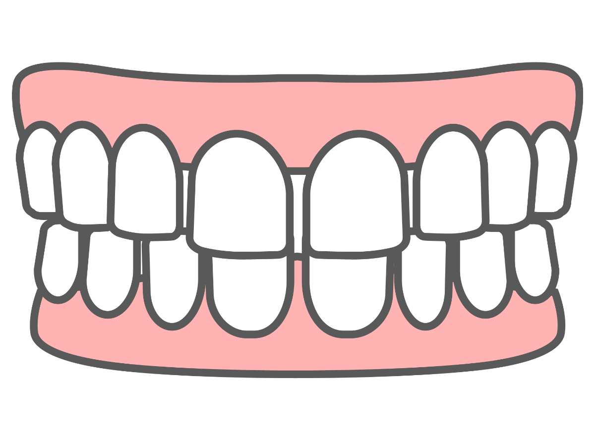 すきっ歯の歯の図