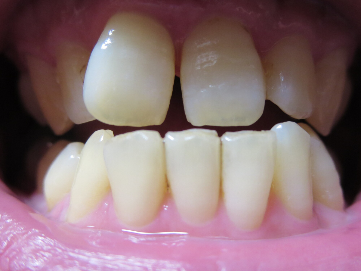 すきっ歯の歯
